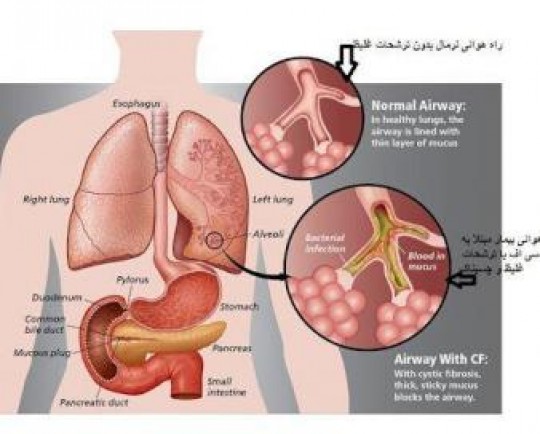 سی اف، پر از رنج و هزینه اما ناشناخته